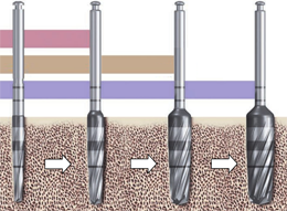 NY式インプラント